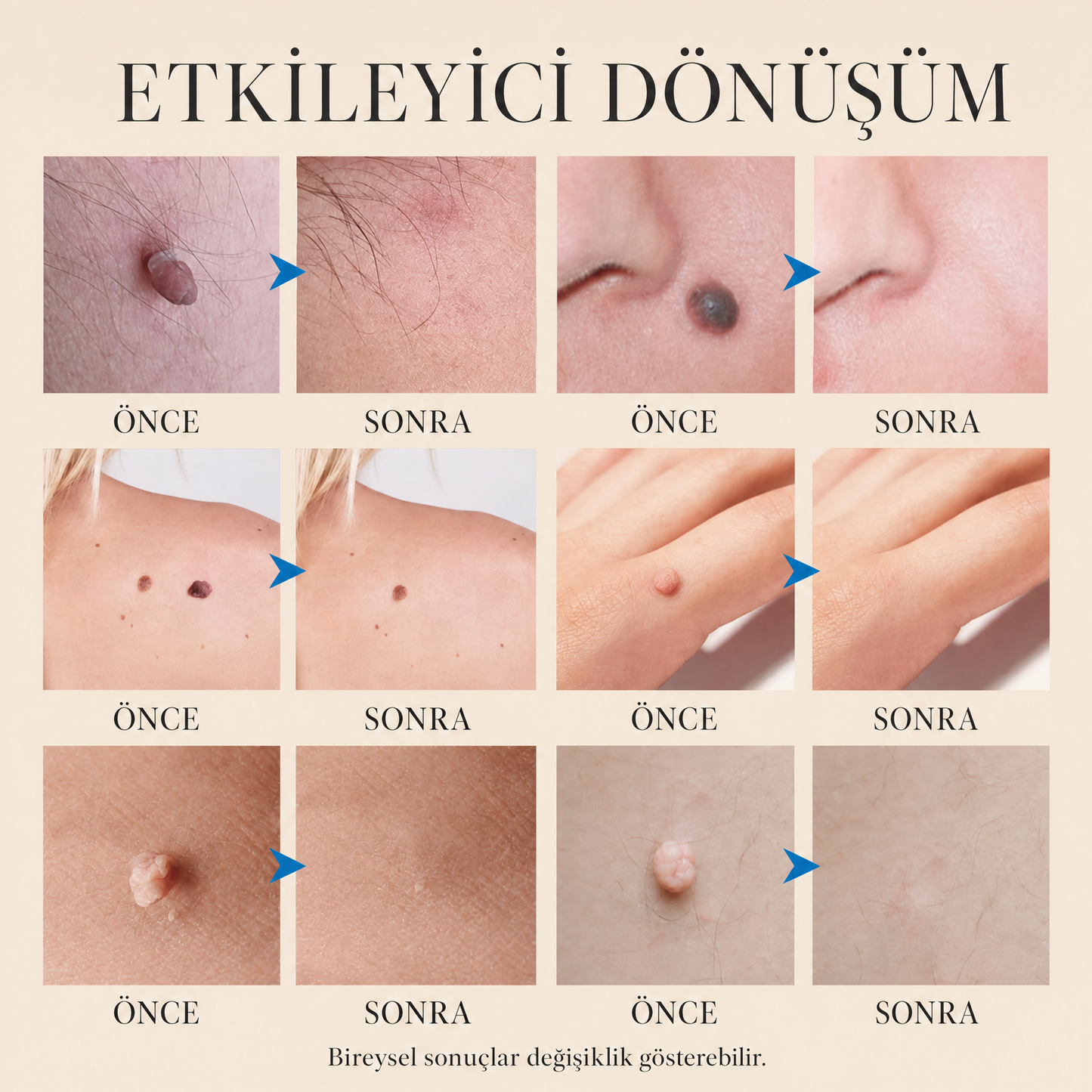 OcuraLife™Lekeleri Yok Eden Cihaz