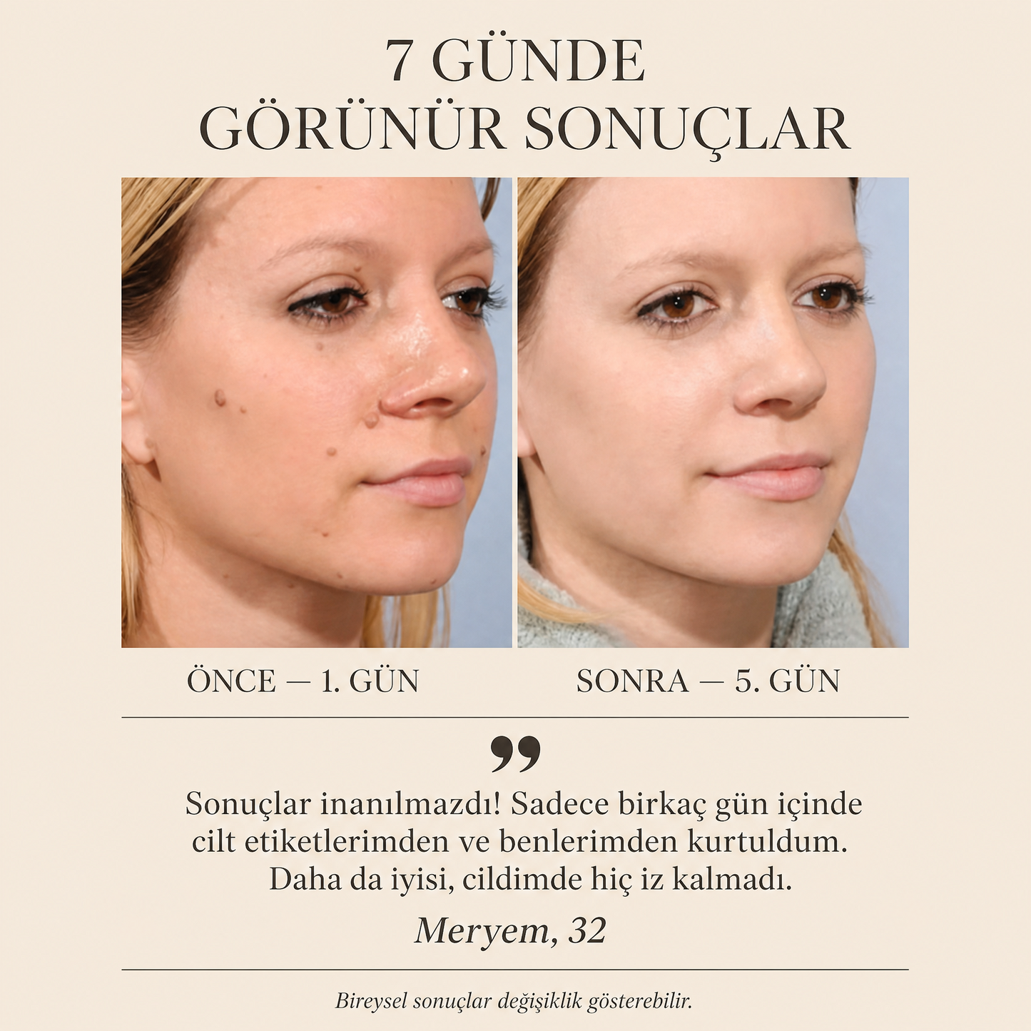 OcuraLife™Lekeleri Yok Eden Cihaz